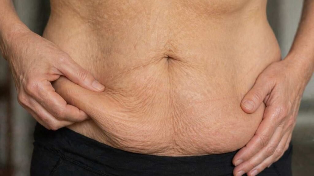 How a tummy tuck addresses loose abdominal skin