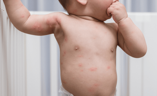 Investigate Potential Dietary Triggers